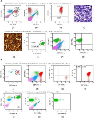 Case report: Two pediatric cases of long-term leukemia-free survival with relapsed acute T-lymphoblastic leukemia treated with donor CD7 CAR-T cells bridging to haploidentical stem cell transplantation